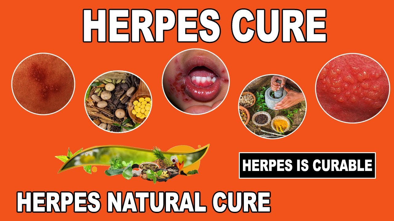 New_Herpes_Cure's tweet card. Herpes Cure 2017 - Breakthrough Herpes Cure Found | Massive News For...