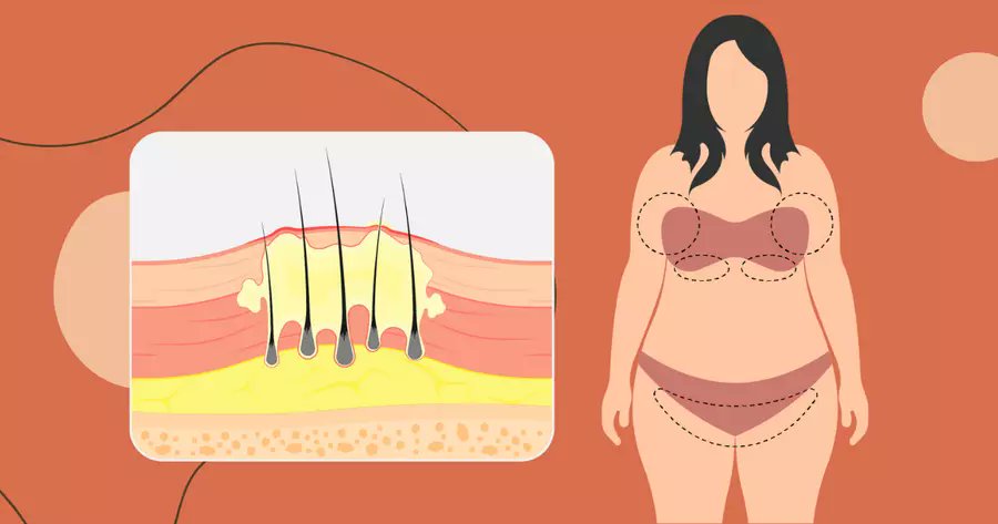 myHSteam's tweet card. Between 1 percent and 4 percent of the U.S. population — up to 13 million people — live with hidradenitis suppurativa..