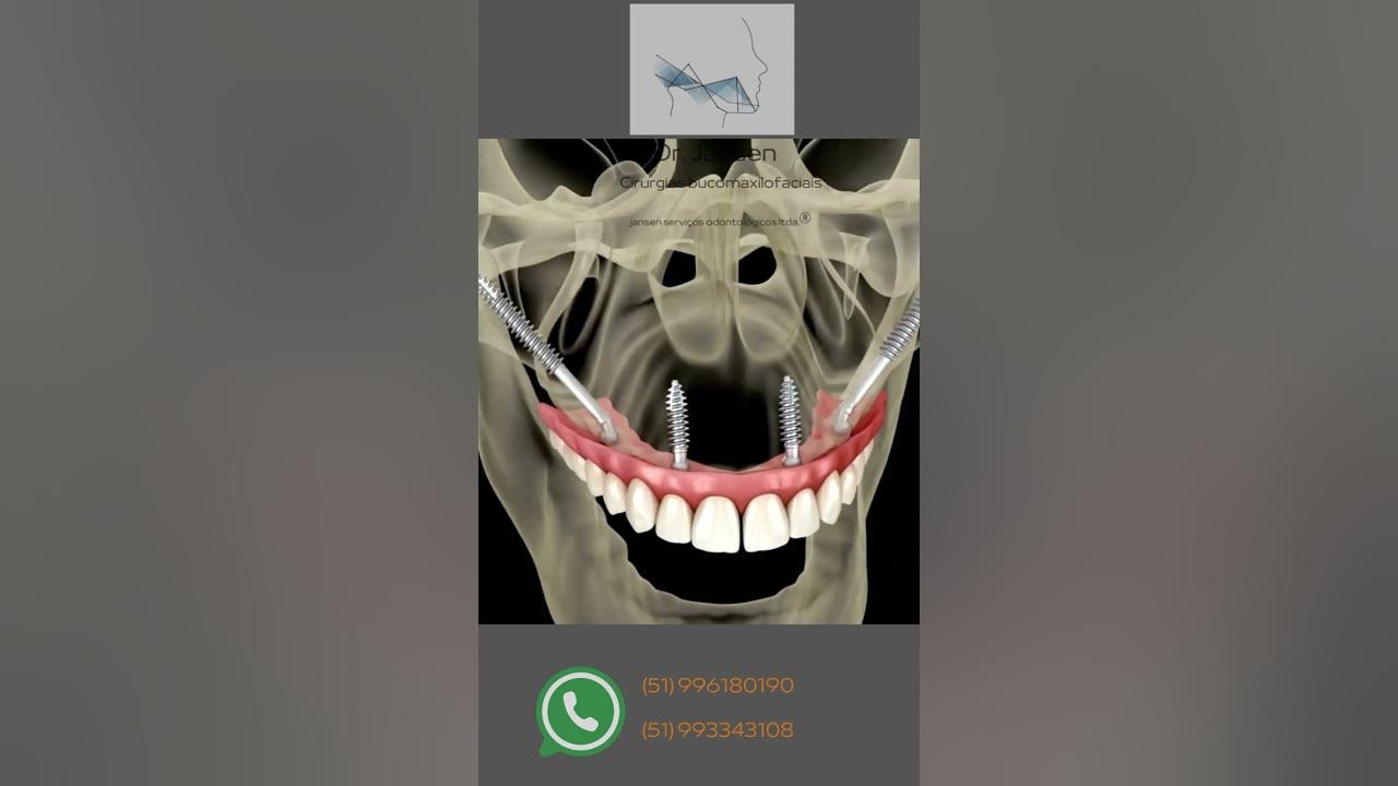 carlosjansen's tweet card. Implantes zigomáticos