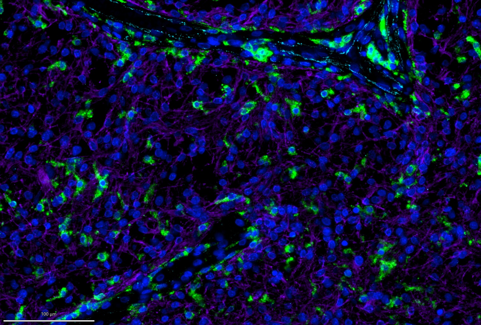 BrainTumorInst's tweet card. Northwestern Medicine investigators have discovered that targeting the TIM3 protein in mouse models of low-grade astrocytoma increased survival compared to current immunotherapies, according to...
