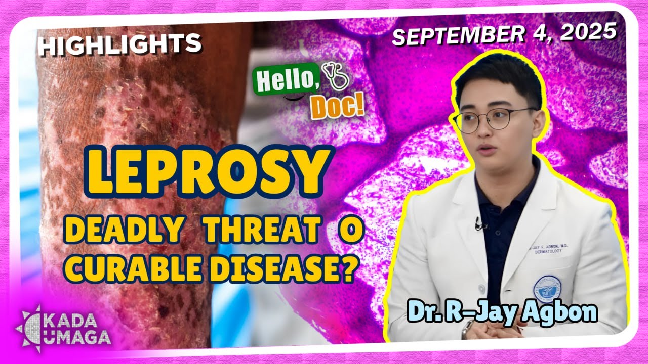 NET25TV's tweet card. Totoo nga ba na nakakahawa ang Leprosy o Hansen's Disease?