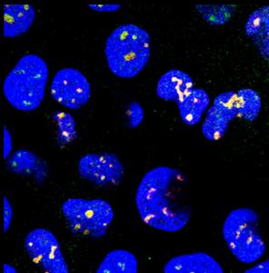 LabZhu's tweet card. Targeting cellular structures called nuclear speckles could be a completely new approach for treating Alzheimer’s, Parkinson’s and prion diseases, according to new research led by the University of...