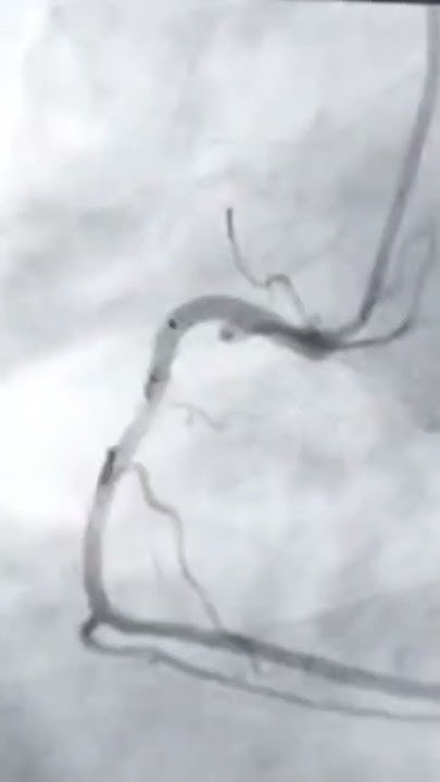 ahmd_zoheb's tweet card. #coronaryangiography #spontaneousrecanalization #slowflow #healthca...