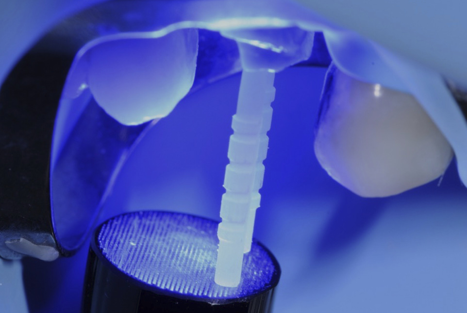 Aurelioralcare's tweet card. With new materials, now it's possible to treat a tooth with multiple problems in 3 single appointments without stress and with patient satisfaction.