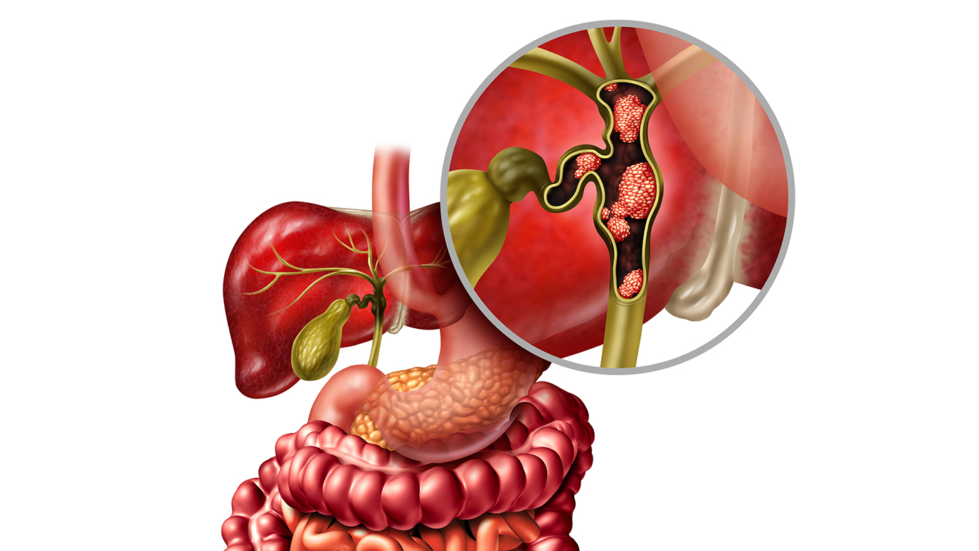 Cancer_Buzz's tweet card. HER2-targeted therapy shows promising results in rare bile duct cancers