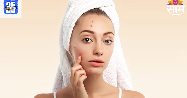 saamTVnews's tweet card. उन्हाळ्यात चेहऱ्यावर पिंपल्स येणे सामान्य आहे, कारण घाम, उष्णता आणि धूळ यामुळे त्वचेवर अनेक समस्यांची वाढ होते. त्यातले एक मोठं असं मुरुमे येणे, जे चेहऱ्यावर खु