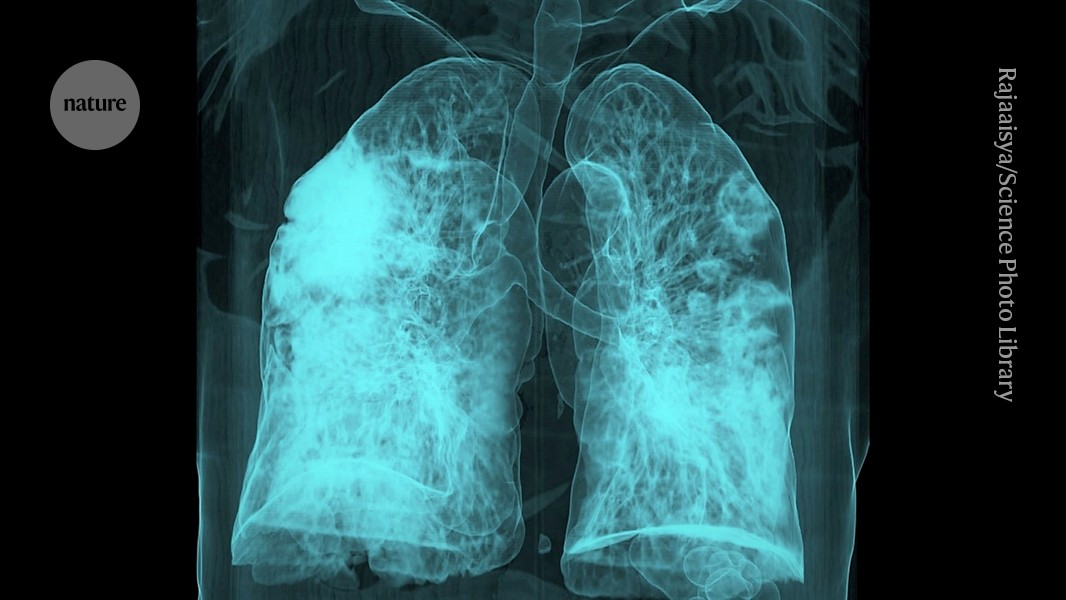 DrPatSoonShiong's tweet card. Nature - Inflammation from the respiratory infections seems to be the culprit, study in mice finds.