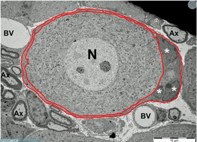 bhanlon15's tweet card. More evidence is presented that the most severely ill fibromyalgia patients have an autoimmune disease.