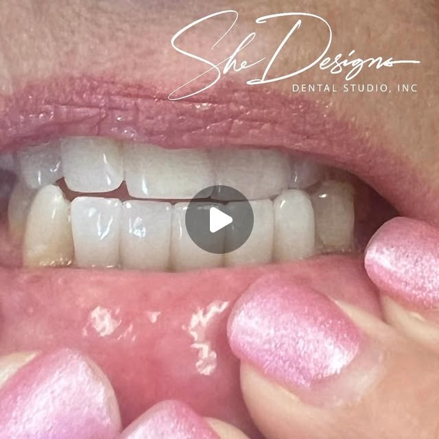 SheDesigns_Lab's tweet card. 🌸 She Designs Dental Studio 🌸 (@shedesignsdentalstudio) • Instagram reel