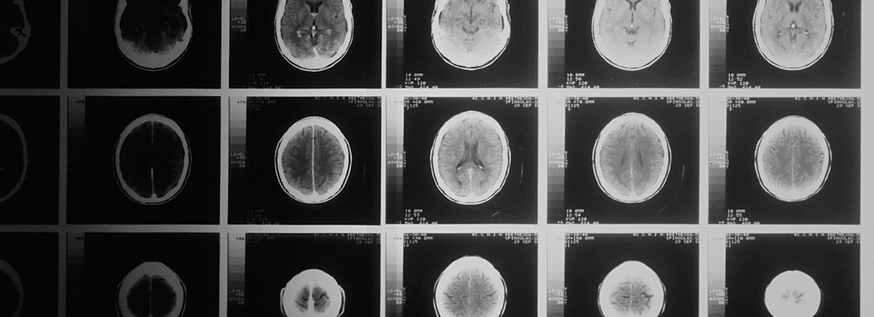 FranceAlzheimer's tweet card. Recherche et modélisation du cerveau Des chercheurs sont parvenus à créer de mini-cerveaux, ce qui permet d'éva...