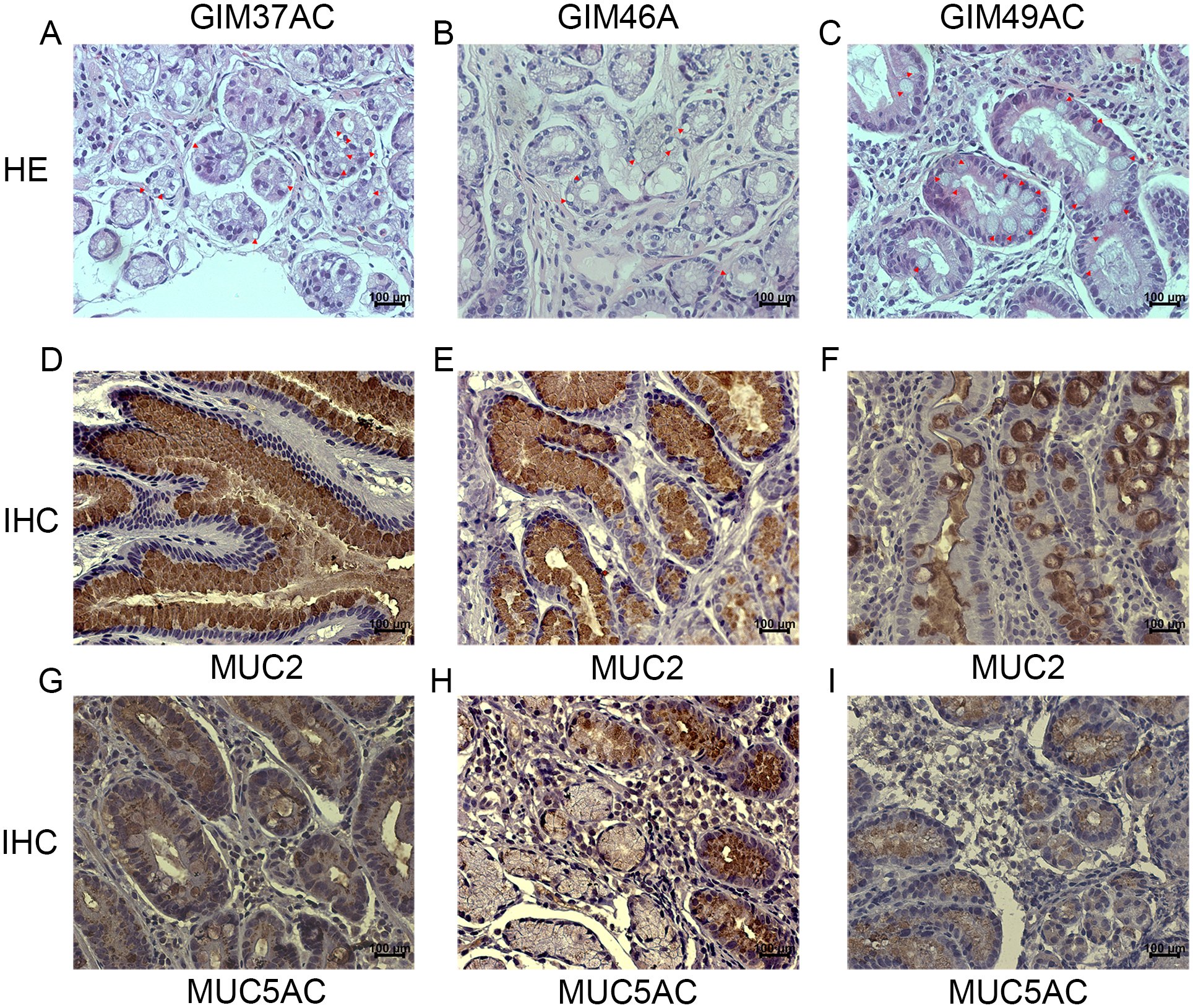 Boc_Lab's tweet card. Journal of Translational Medicine - Gastric intestinal metaplasia (GIM) is an essential precancerous lesion. Although the reversal of GIM is challenging, it potentially brings a state-to-art...
