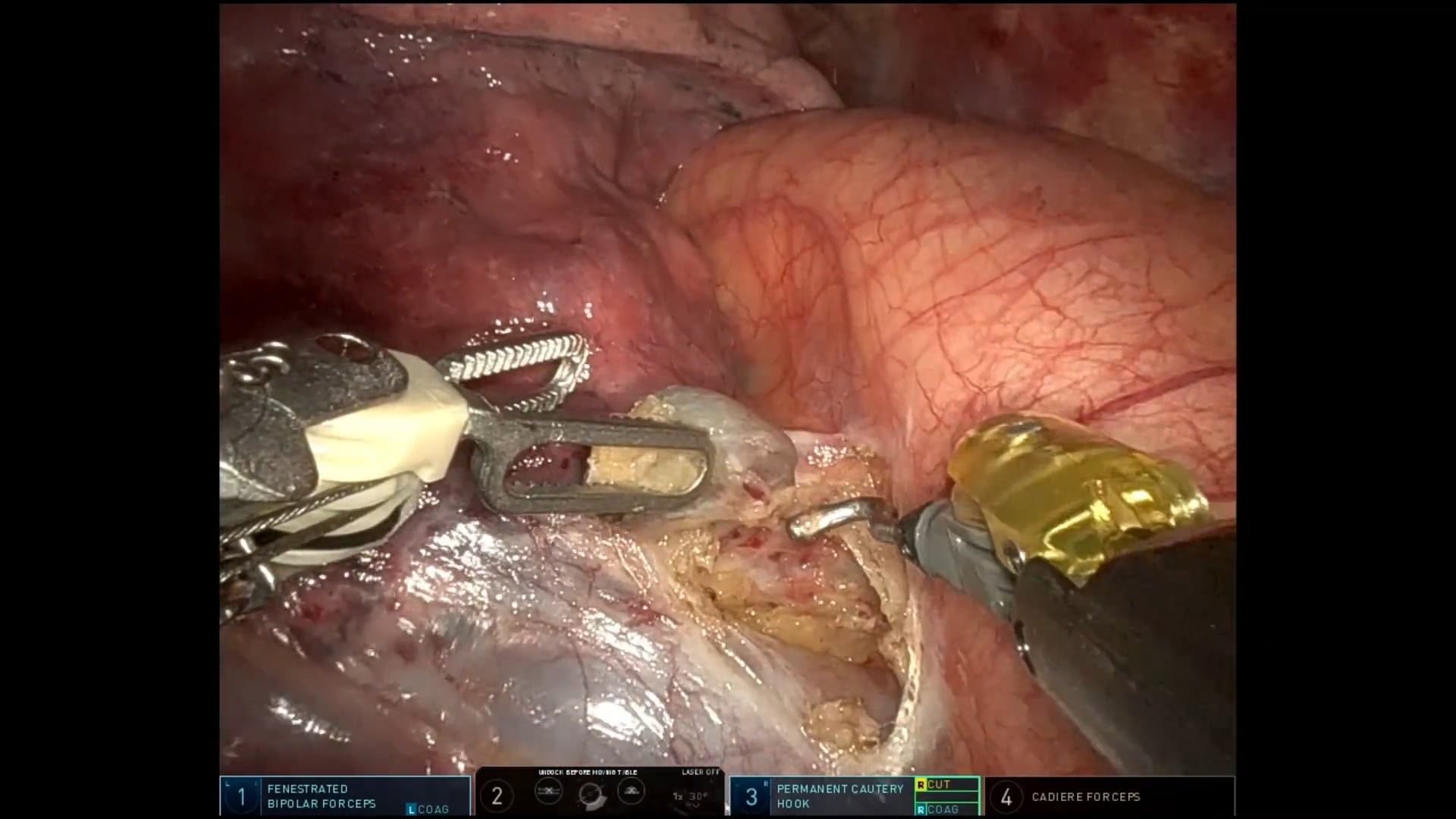 EACTS's tweet card. Segmentectomies Made Easy series: robotic-assisted left S1, S2 and S3 trisegmentectomy