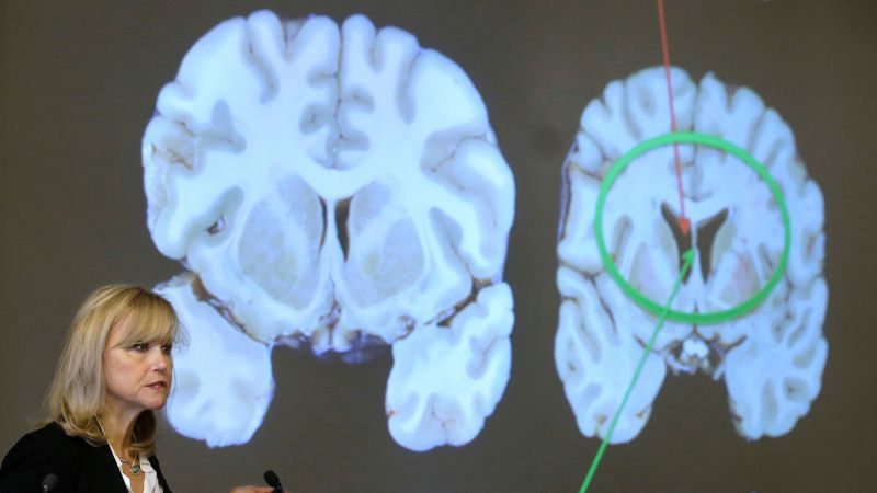 DrColleenHacker's tweet card. The neurologic disease called chronic traumatic encephalopathy or CTE has most often been found in people who experienced repeated blows to the head while playing contact sports and there’s now...