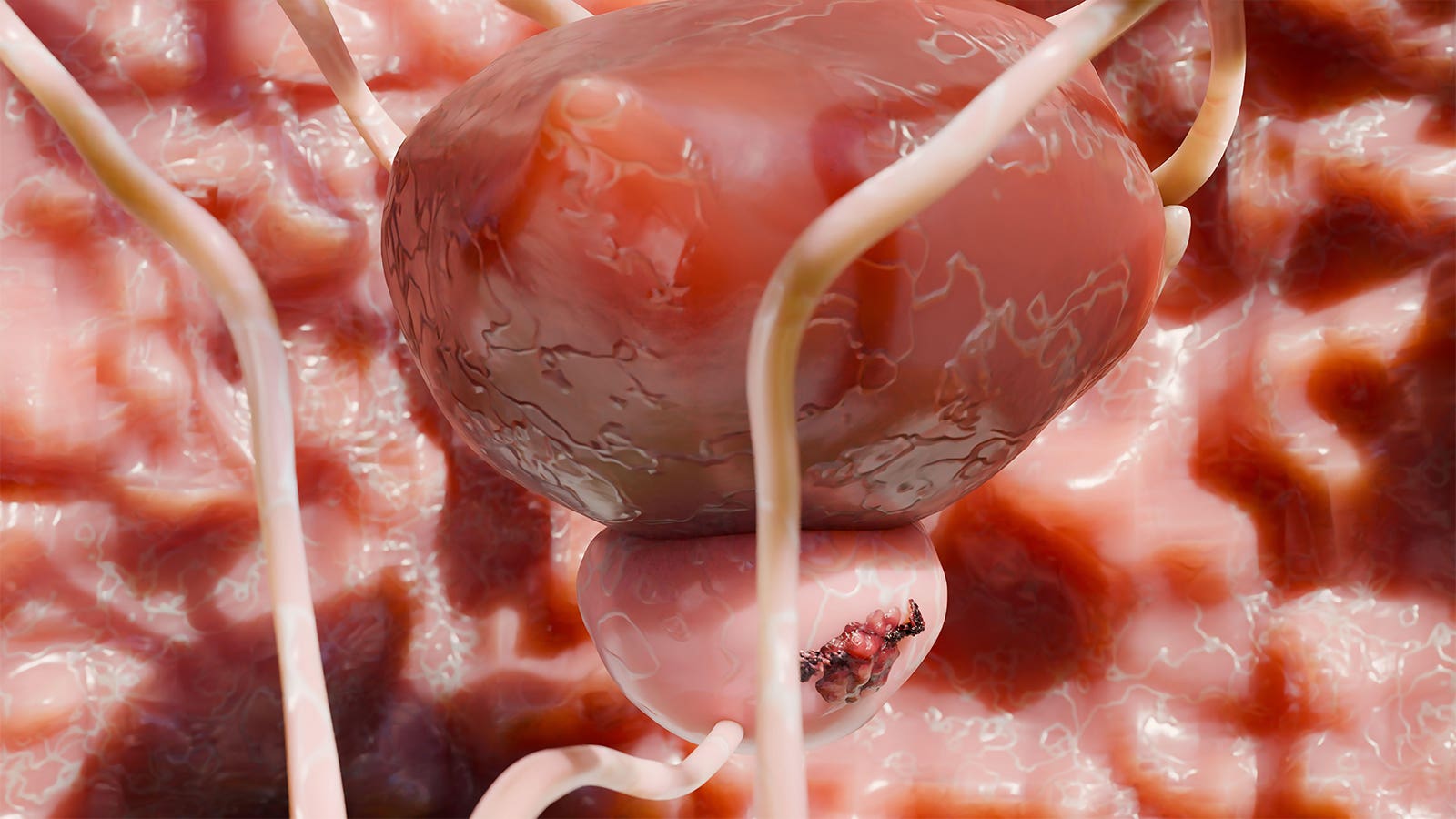 elmodir's tweet card. At 23 years, prostate cancer mortality was 13% lower among men who underwent screening