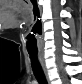 OperativeTechn1's tweet card. Imaging is critical in the evaluation and accurate staging of the patient with laryngeal cancer. Knowledge of relevant anatomy and characteristic patterns of tumor spread guides prognosis and...
