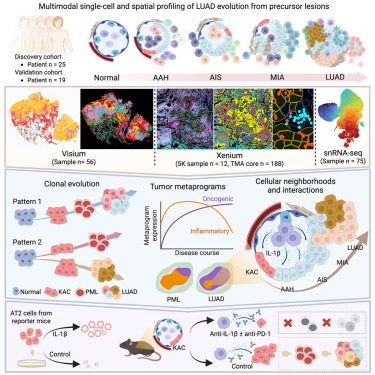 IamLinghua's tweet card. By single-cell and spatial transcriptomics analysis, Peng et al. reveal that alveolar progenitors are the earliest predecessor of LUAD and reside in epithelial-proinflammatory niches that are more...