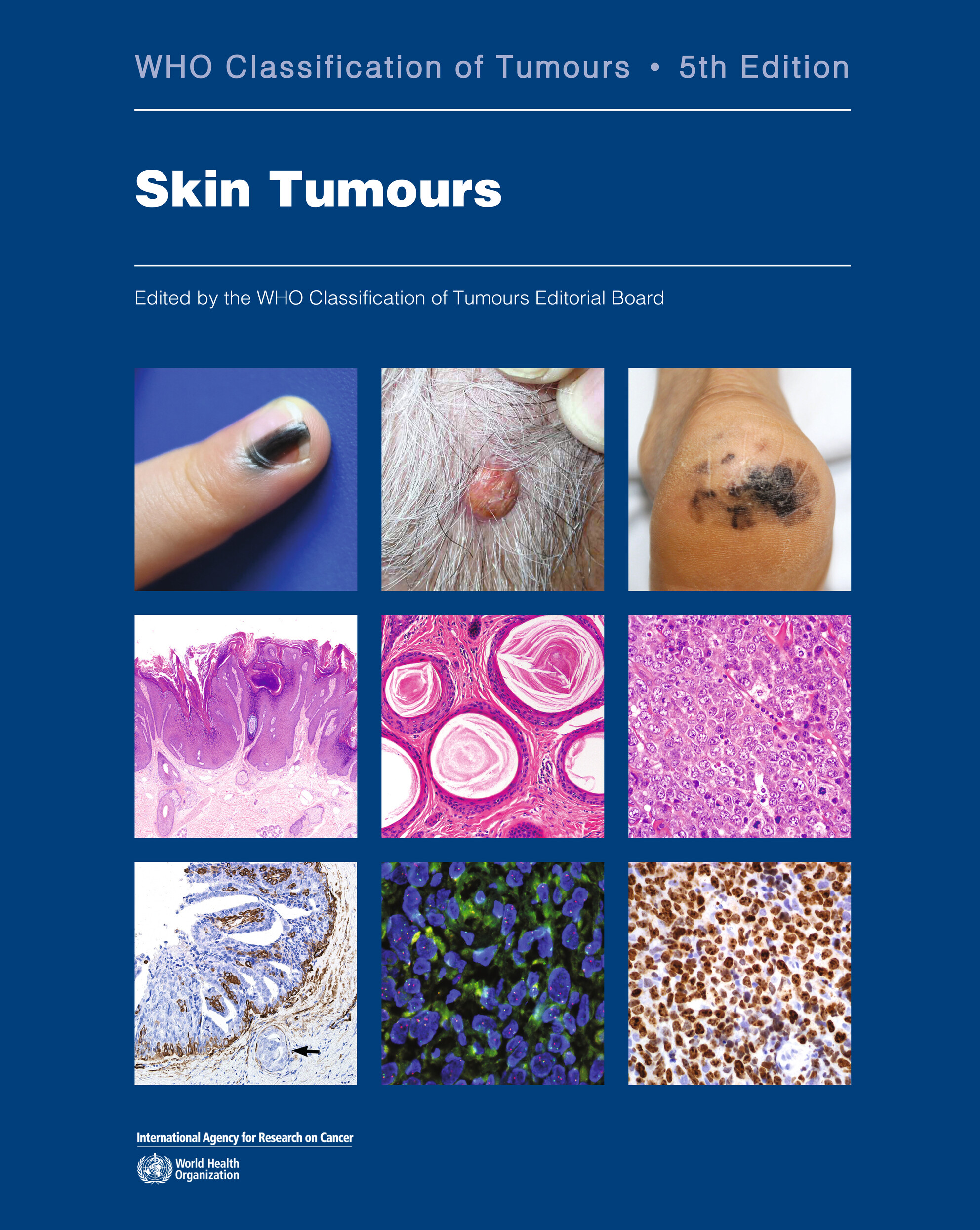 Histo_Journal's tweet card. This review article summarizes the key updates in the 5th edition of the WHO Classification of Skin Tumours. It provides an overview of the major changes and new entities specific to the skin...