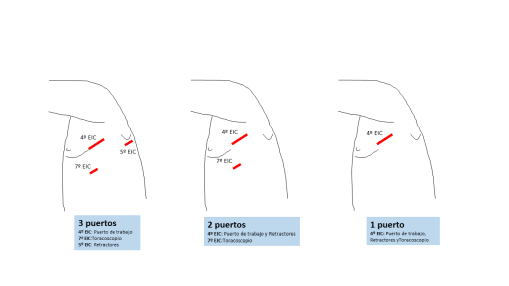 NeumoMadrid's tweet card. La cirugía torácica videotoracoscópica o VATS (video-assisted thoracoscopic surgery) comenzó a desarrollarse en la década de los 90.