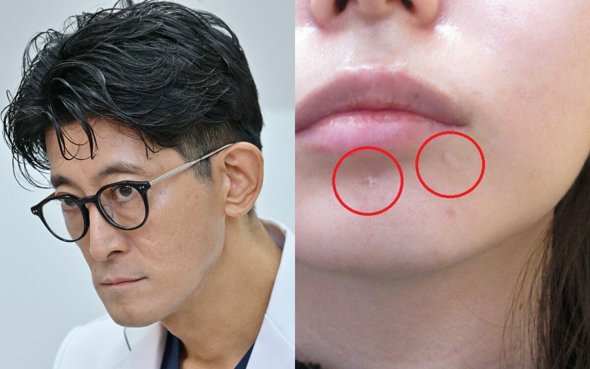 I7Zmw3yHCvnaWsn's tweet card. 「キレイになりたくて大金を払ったのに」「もう誰にも会いたくない」形成外科医の村松英之さん（50）の元には、美容整形の術後の傷あと相談をする患者が増えている。「確かに“こんな傷あとありえない”と思うケー…