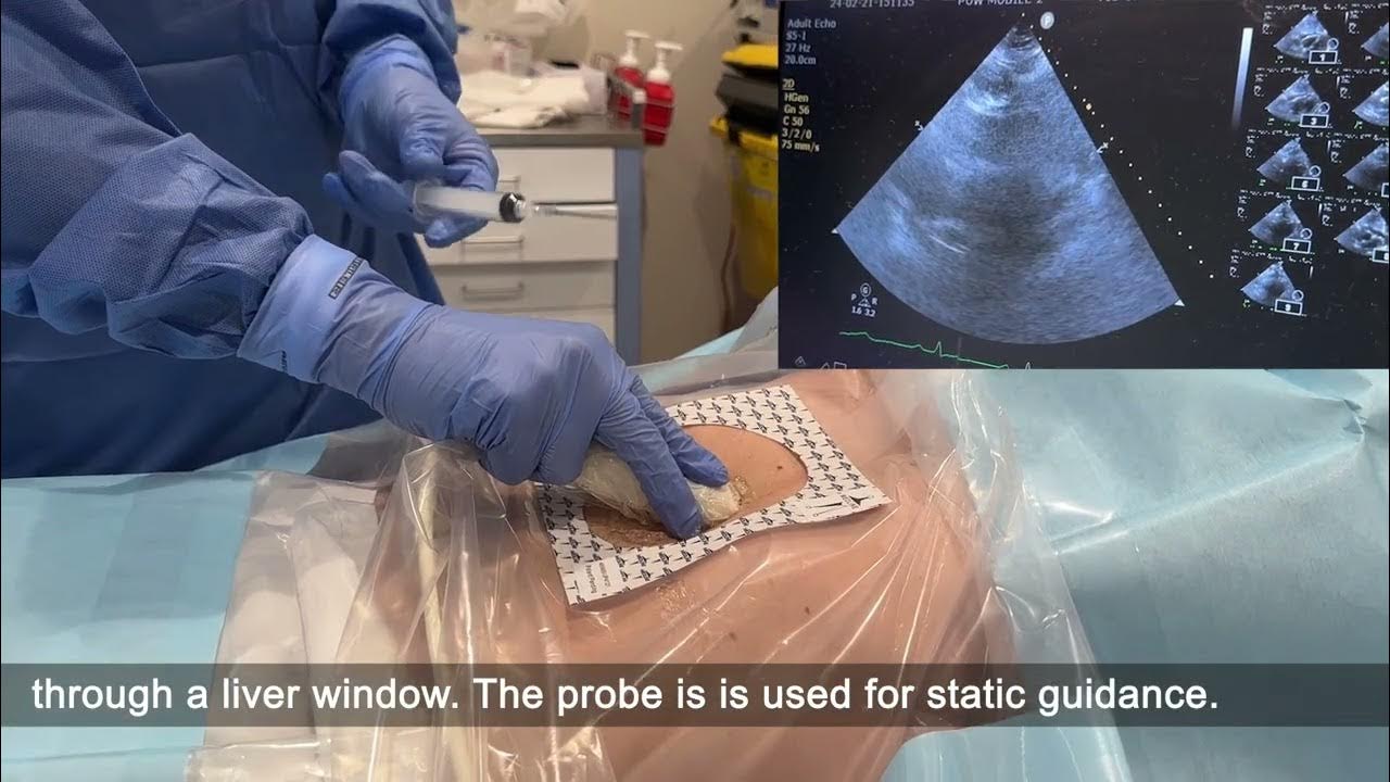 cliffreid's tweet card. Emergency Department Pericardiocentesis