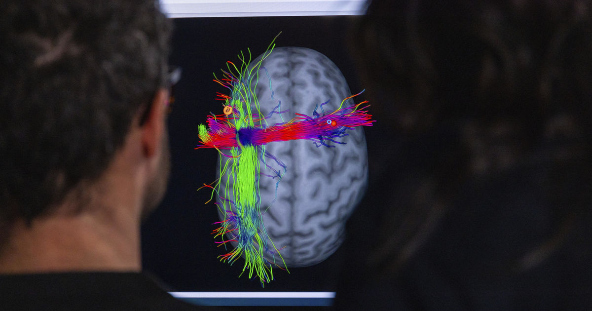 AaltoTechsperts's tweet card. Kun algoritmi ottaa ohjat, aivojen magneettistimulaatiosta tulee nopeampaa ja tehokkaampaa. Menetelmä tuo uusia mahdollisuuksia muun muassa vakavan masennuksen ja kivun hoitoon.