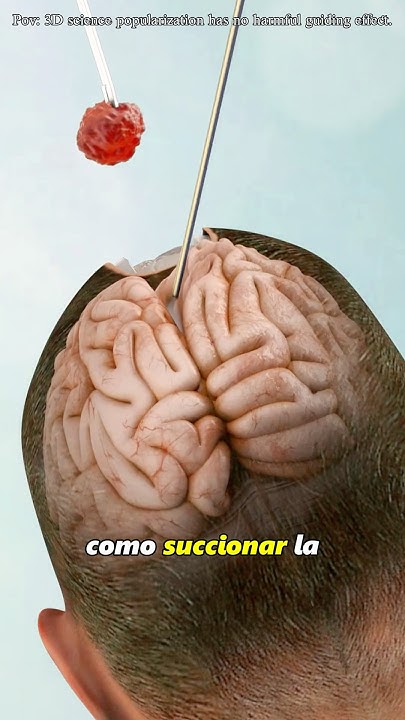 Dimirogo's tweet card. Brain Tumor treatment Craniotomy: 3d animation #youtubeshorts...