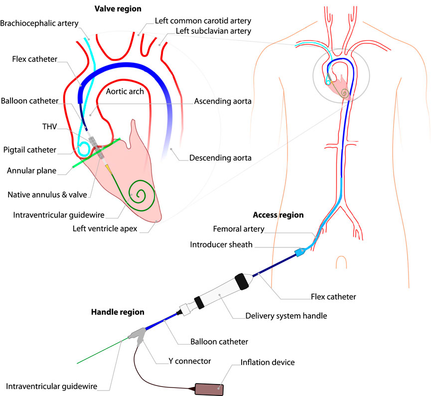 FrontComputSci's tweet card. Transcatheter Aortic Valve Implantation (TAVI) is a minimally invasive procedure in which a transcatheter heart valve (THV) is implanted within the patient’s...