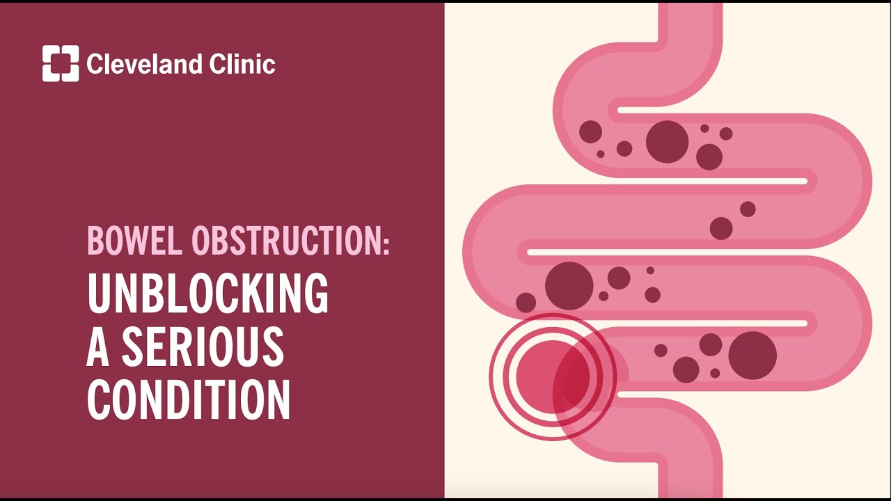 MEOnly1234567's tweet card. Bowel Obstruction: Unblocking A Serious Condition