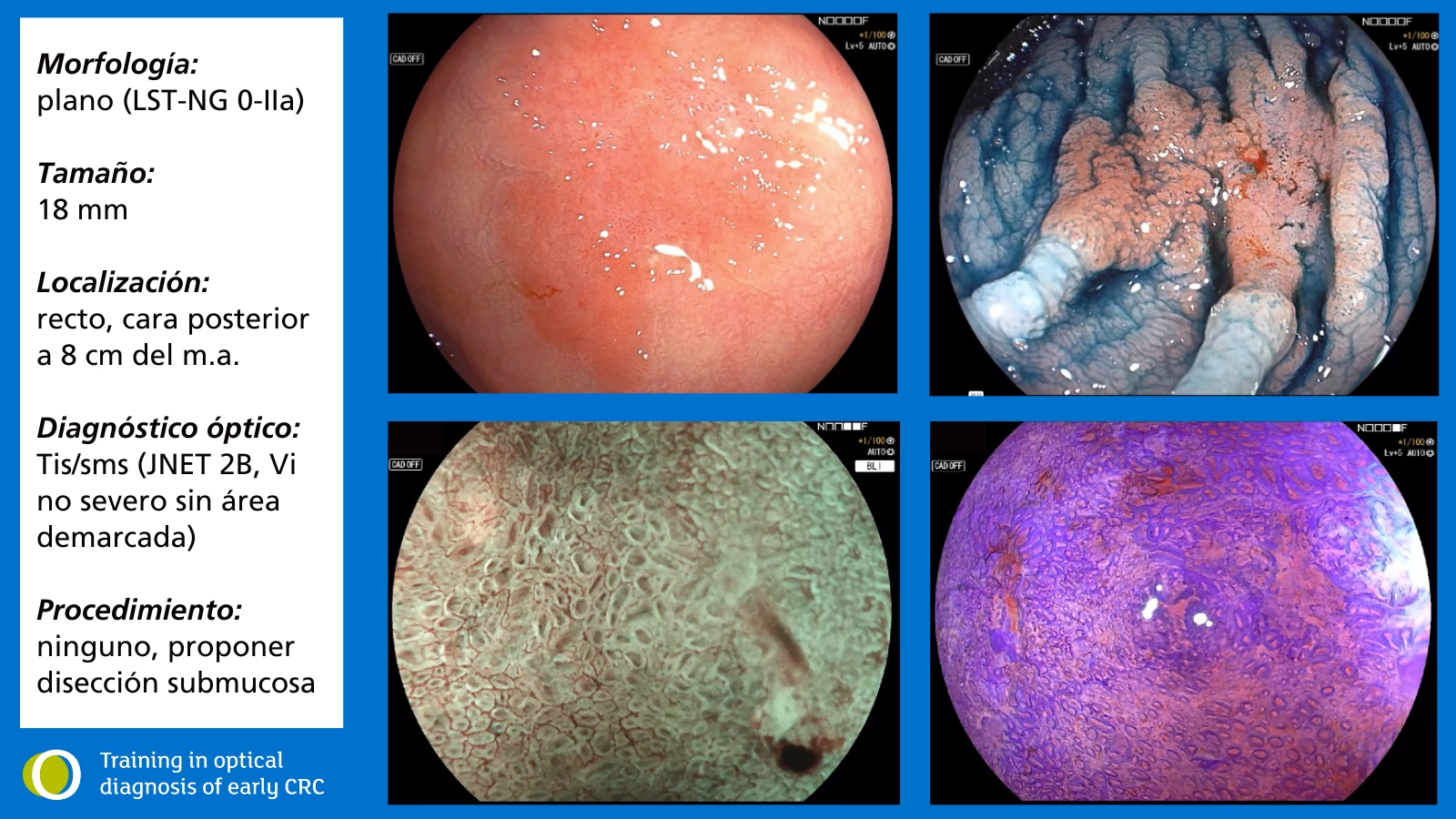 todearlycrc's tweet card. Domina el diagnóstico óptico del cáncer colorrectal precoz. Aprende técnicas avanzadas de imagen, mejora la precisión diagnóstica y optimiza los resultados de tus pacientes con nuestro completo...