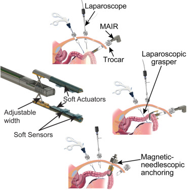 TommasoRanzani's tweet card. A soft laparoscopic grasper demonstrates atraumatic manipulation of the small intestine, both in physiological and diseased states. The grasper is also used for passive intestinal retraction,...