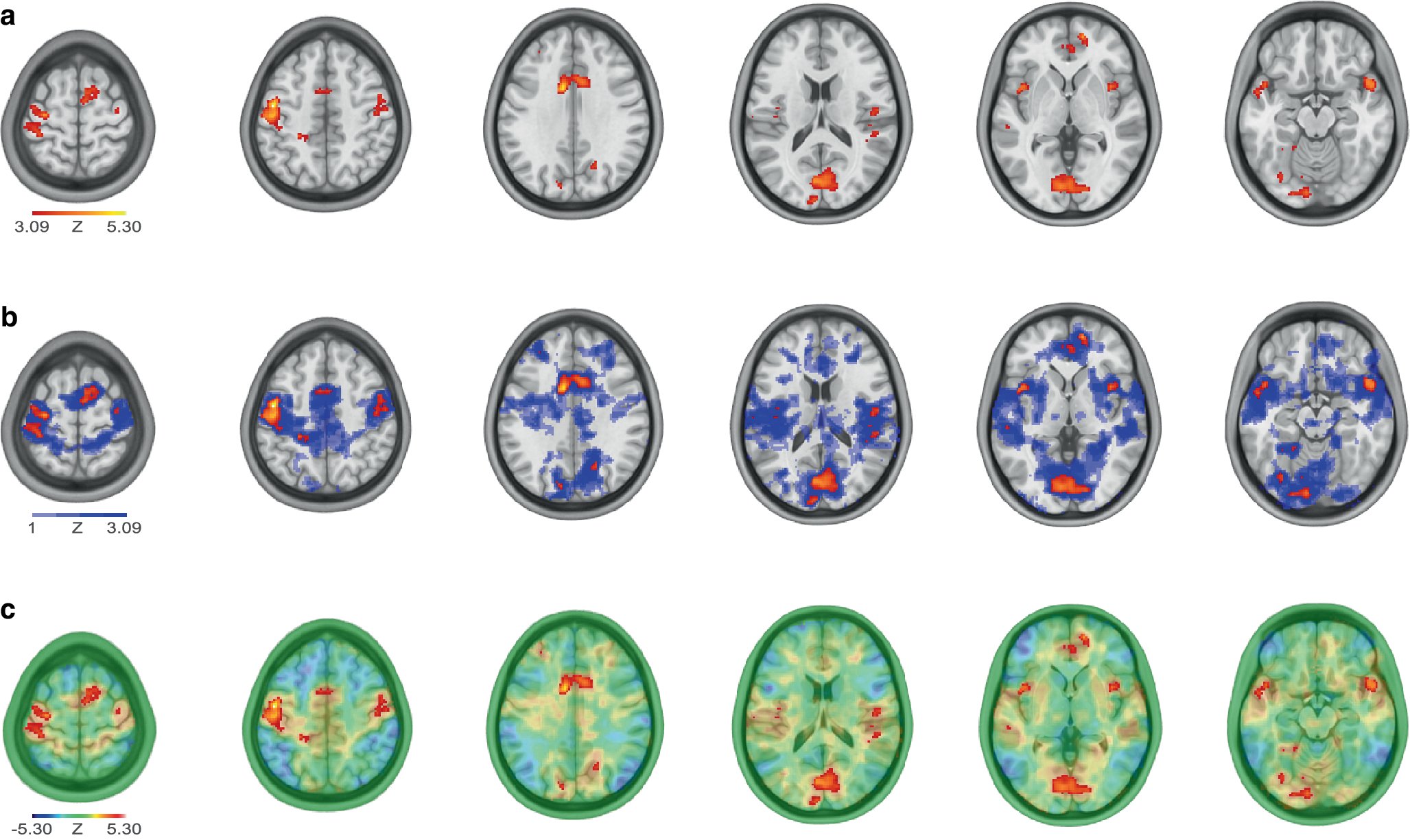 benedikt_sun's tweet card. Clinical Neuroradiology - Many functional magnetic resonance imaging (fMRI) studies and presurgical mapping applications rely on mass-univariate inference with subsequent multiple comparison...