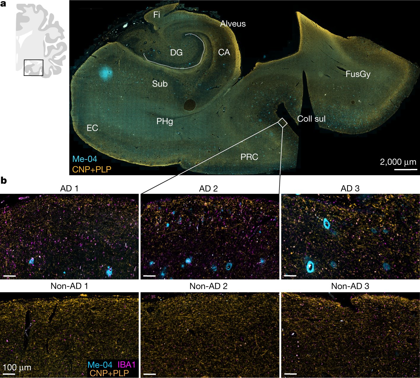 KlausNave's tweet card. Nature - Mouse models show that myelin dysfunction and associated inflammation increase with age, which can promote amyloid-β deposition and therefore risk of developing Alzheimer’s...