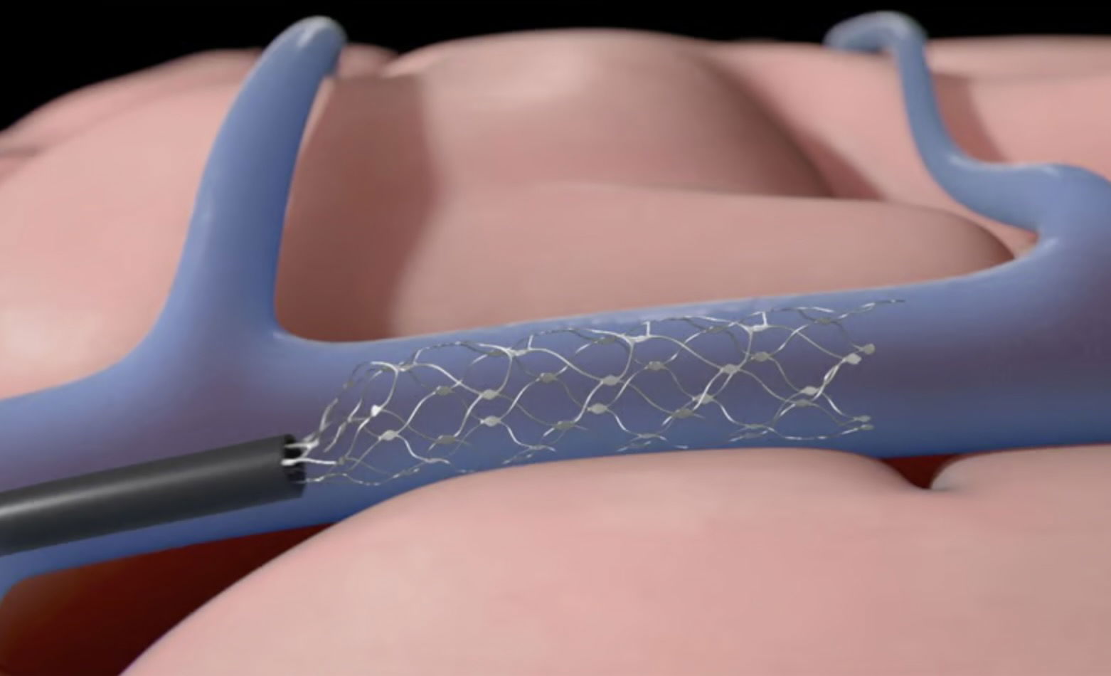 Debriefmedia's tweet card. Synchron has revealed the world’s first public demonstration of an iPad controlled purely by thought.