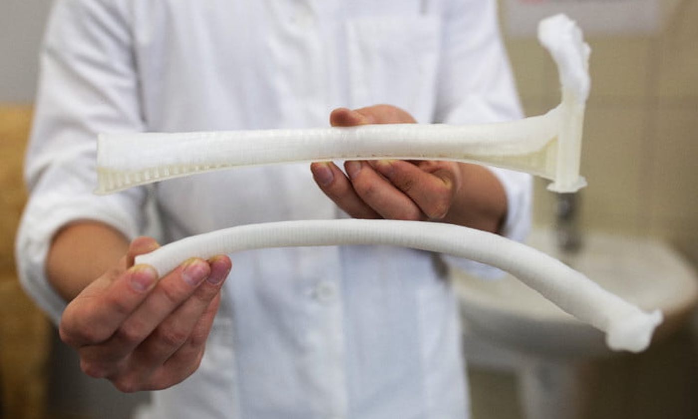 trishellis7's tweet card. The patient has been in “perfect health” since receiving a $114 3D rib implant—and surgeons hope to take full advantage of the medical breakthrough.