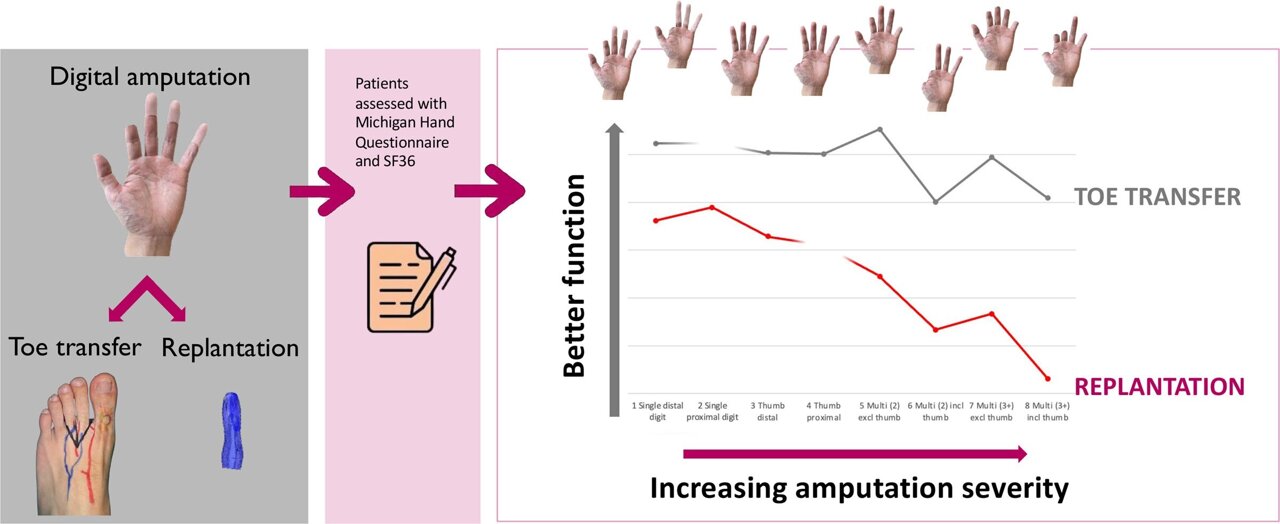 medical_xpress's tweet card. For patients with amputations affecting the hand, toe transfer surgery provides an alternative to replanting the amputated digits and may lead to greater improvement in hand function and other key...