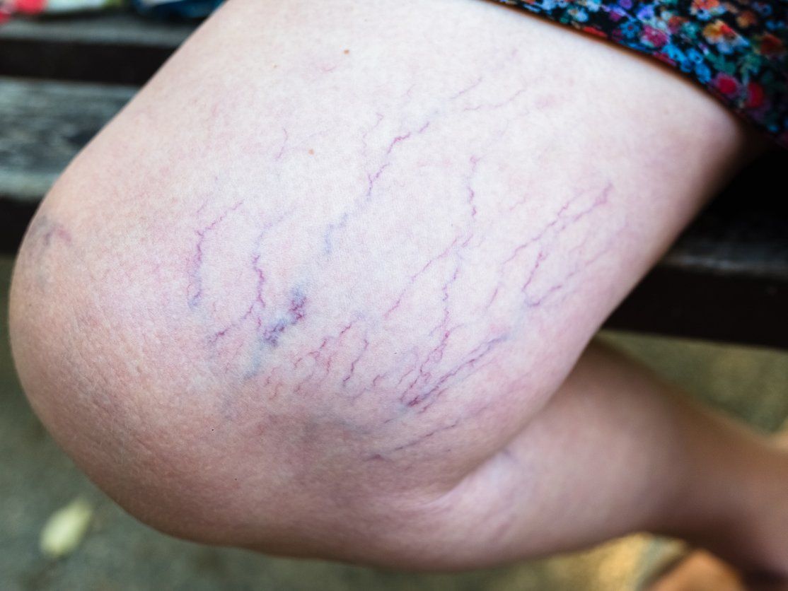 liverbasics's tweet card. While some of the most common symptoms of non-alcoholic fatty liver disease are fatigue, abdominal discomfort, red palms and jaundice – some telltale signs appear on the skin when the condition is in...