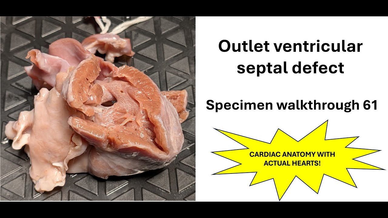 loomba_rohit's tweet card. Specimen walkthrough 61- outlet VSD, ASD | Cardiac anatomy!