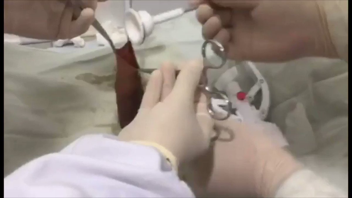 Circoncision  tuli 