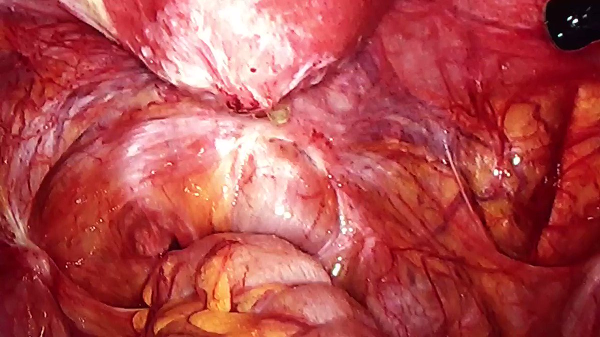 Course on advanced gynecology surgery #HospitalLaPaz. Deep endometriosis with previous placement of bilateral lighted ureteral catheters for laparoscopic approach @Uroweb @UrowebESU @eauesut @SeclaEndosurg @malvarezmaestro @young_endosoc @endourologyccf