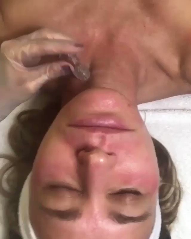 @AquagoldFT is a revolutionary device that is able to treat both small delicate areas such as the neck & under eyes, or be administered to larger parts of the body such as the full face & even the scalp!
📹 @medphysiqueatx
#aquagoldfinetouch #microchanneling #medicaldevice