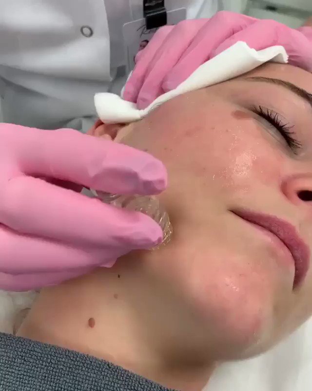 Plump💦 and perfect 💎your skin with little to no 🚫pain or downtime with @aquagoldfinetouch!
Courtesy of @akademiklinikennorge (Norway)
*Medical grade device. Sold only to licensed professionals.
#aquagoldfinetouch #microchanneling #medicaldevice