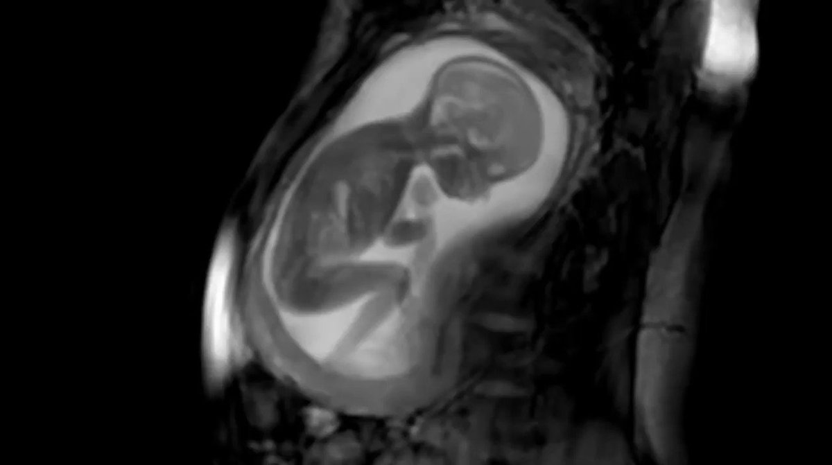Saintis berhasil mengembangkan teknologi MRI yg bisa menghasilkan citra super jernih. MRI ini dikembangkan para saintis di King's College London bekerjasama dgn IFind (Intelligent Fetal Imaging and Diagnosis).
Sains membuat kita bisa menyaksikan aksi lucu sang CALON bayi.