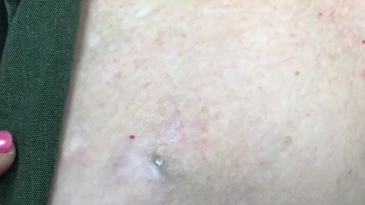 A hidden cyst with a dilated pore is like a brick in the wall...#drpimplepopper #happysunday
