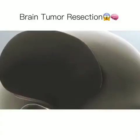 Brain Tumor Resection