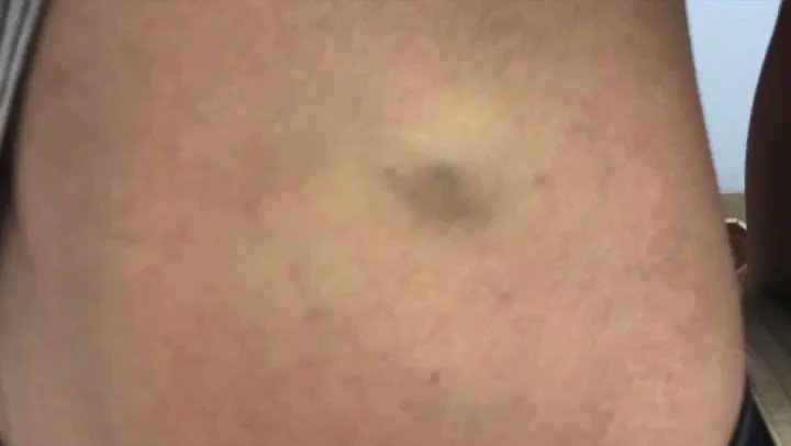 MONDAY... #drpimplepopper