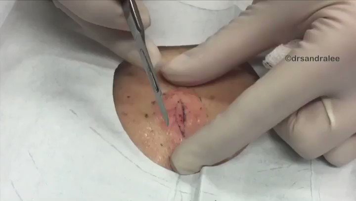 Whoβs looking forward to THIS WEEKEND?! ππΌπππΌ#Drpimplepopper π#stpatricksday