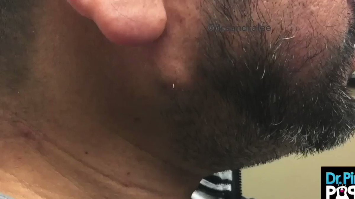 Itβs πͺ day but this weekend itβs ππΌπππΌ! #drpimplepopper π