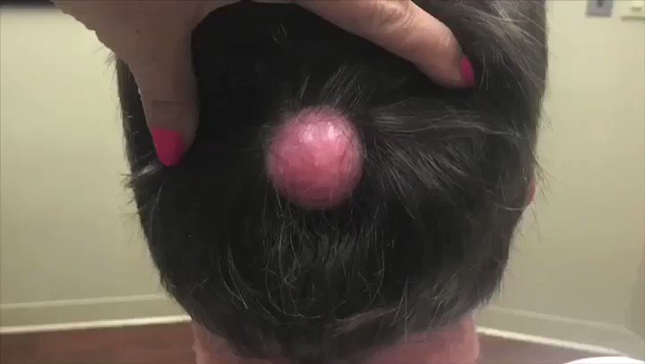 Do you REALLY want eyes behind your head? #eyeswithoutaface #billyidol #drpimplepopper #pilarcyst