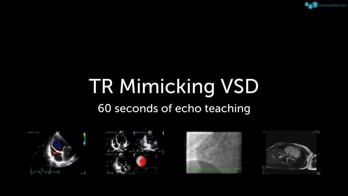 60 Seconds of Echo Teaching Answer: This was NOT a VSD but rather a TR jet - there is no flow convergence zone on the LV side of the IVS as in a VSD. But what is the underlying problem?
#Echocardiology #eLearning #MedicalUltrasound