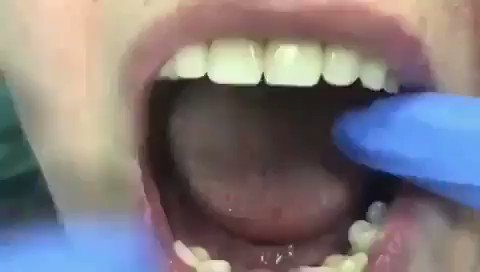 Extremely wobbly teeth !! Dentist call this parodontopathy . it destroys all the supporting tissues of the tooth.